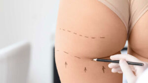 Resultados Increíbles en la Transferencia de Grasa a los Glúteos en guadalajara